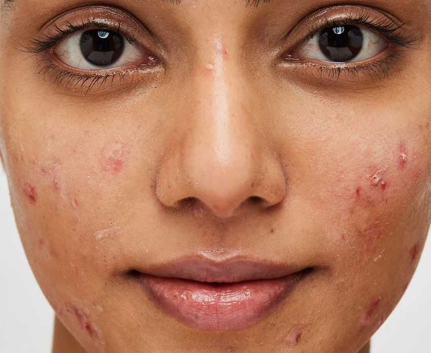 Micro-Inflammation: The Silent Trigger Behind Persistent Acne
