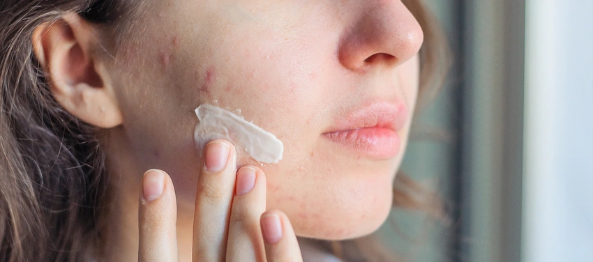 The Acne Plateau Trap: Why Your Skincare Stops Working After Initial Results