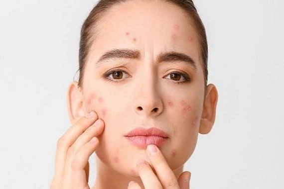 Why Your Skin Remembers Everything: The Lingering Science Behind Breakouts and Marks