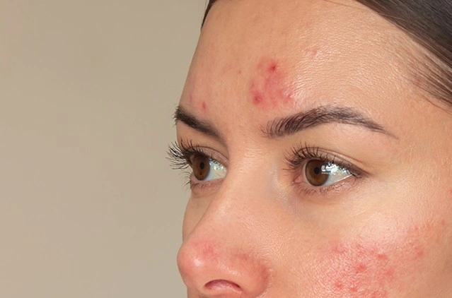 Why Acne Scars Look Worse In Artificial Lighting
