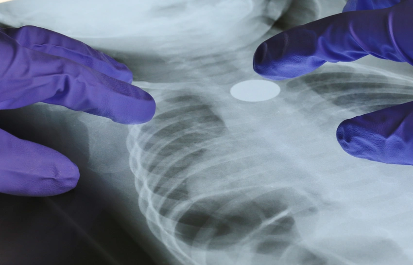 Rare Gene Mutation Unlocks Lung Cancer Risk for Non-Smokers!