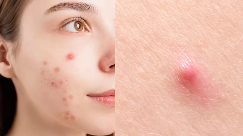 The Invisible Architecture of Acne: How Skin Structure Shapes Breakouts