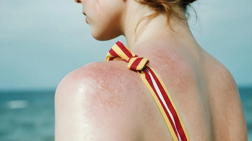 TikTok's 'Sunburning' Acne Trend: Your Skin Deserves Better!