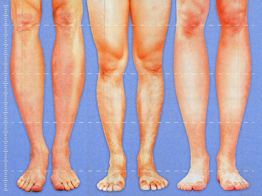 Taller Dreams? Leg-Lengthening Surgery's Unstoppable Rise!