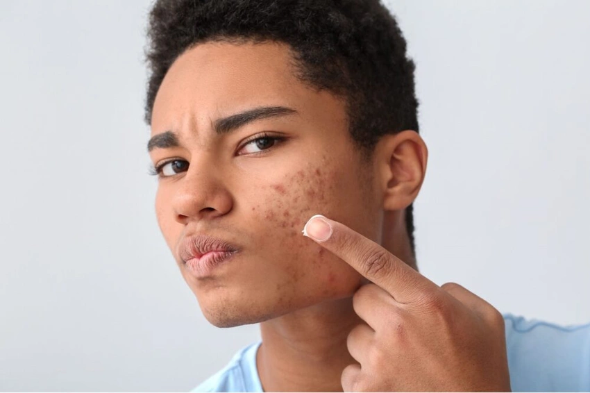 Neurocutaneous Feedback Loops in Acne: How Stress Signaling and Skin Recovery Cycles Interact in Mod