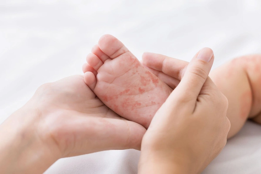 Bangladesh Launches Emergency Measles Vaccination Drive After Child Death Toll Passes 100