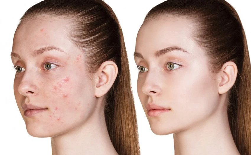 Acne Care for Night Shift Lifestyles: How Circadian Disruption Changes Skin Behavior