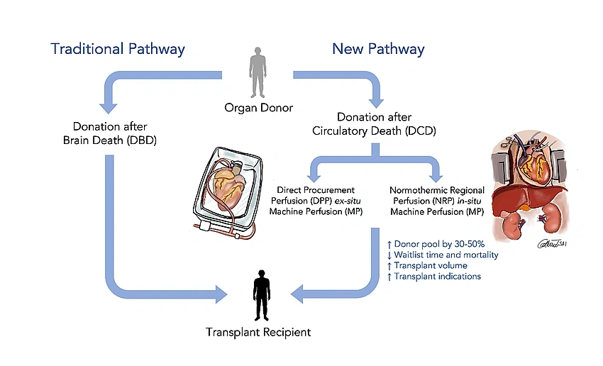 Delhi Doctors Restart Blood Flow After Death for Organ Donation, Asia's First