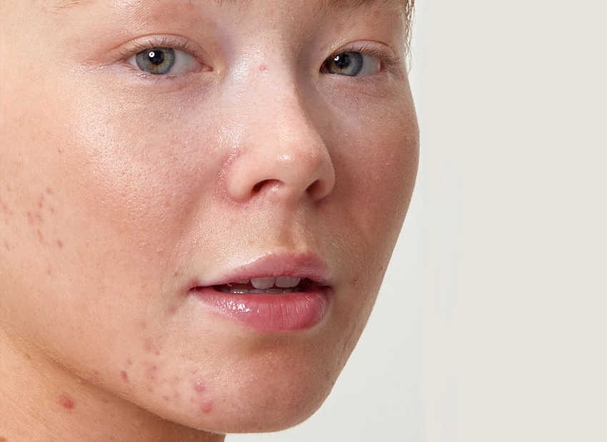 Why Some Acne Marks Stay for Months Even After Pimples Disappear