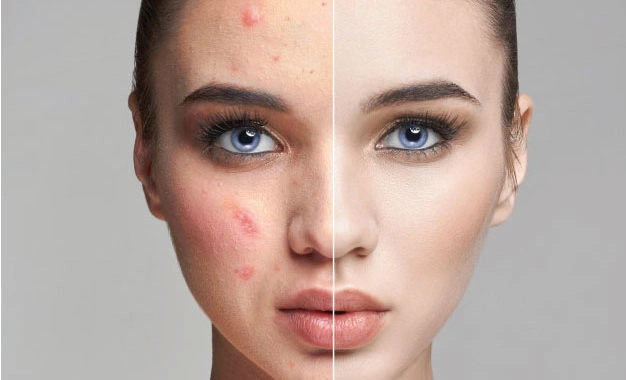 The Shadow Phase of Acne: Why Scars Form Even After Your Skin Looks Clear