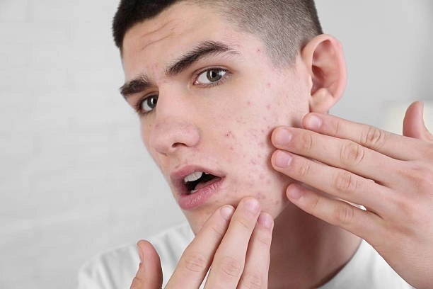 Why Your Skin Breaks Out More During Seasonal Transitions Than Summer or Winter Alone