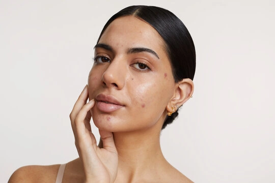 Acne Scars Explained: Why Skin Memory Makes Marks Last Longer