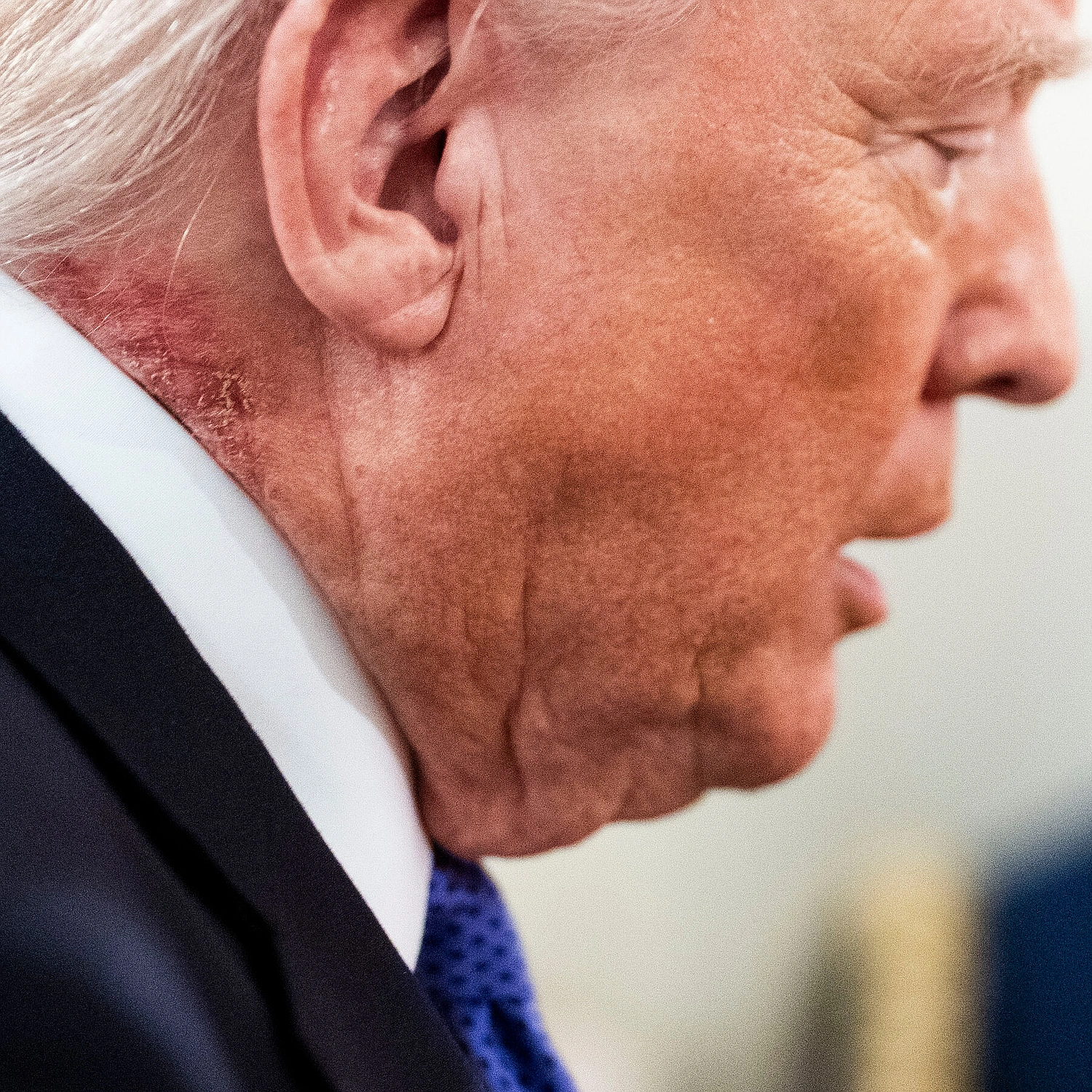 Trump's neck rash linked to common skin cream, doctors say