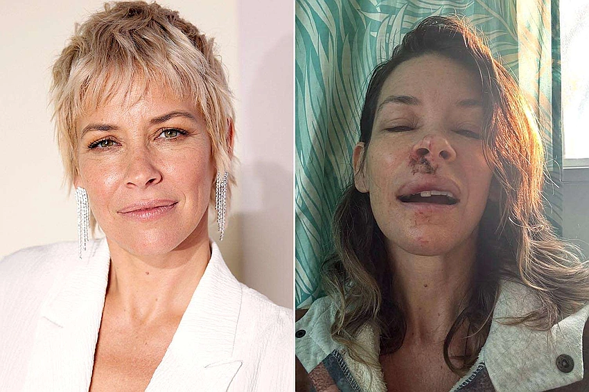 Evangeline Lilly reveals brain damage months after May concussion