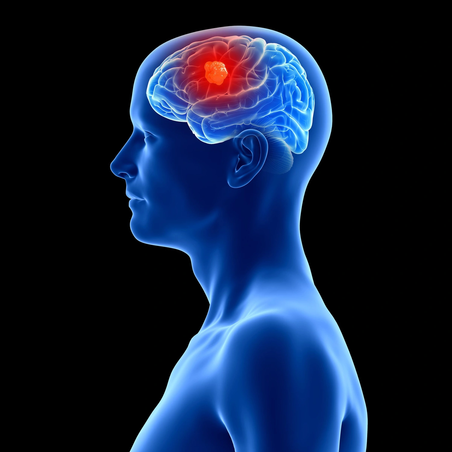 Brain Implants for Cancer: Sci-Fi Hope or Ethical Minefield?