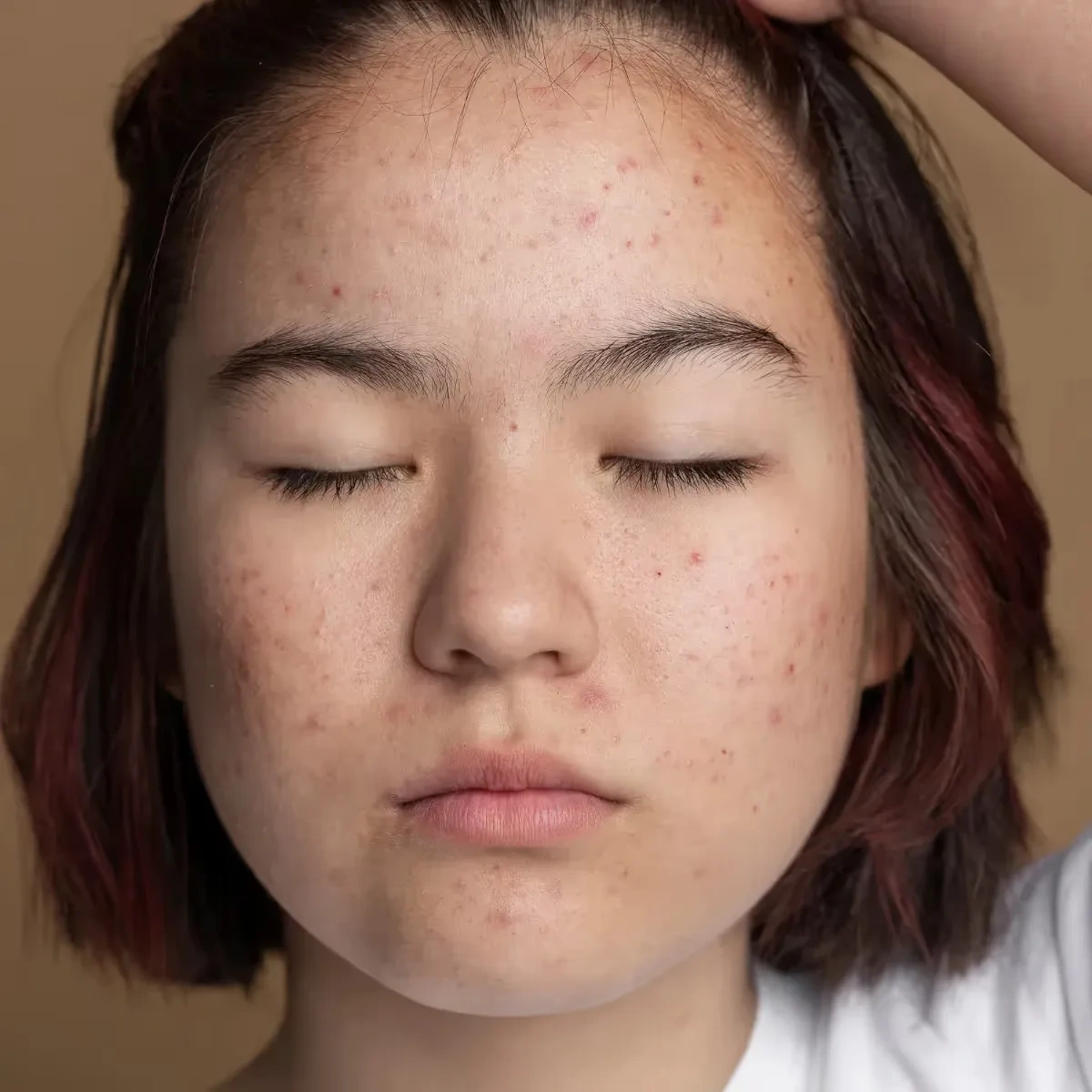 Why Some Pimples Leave Marks Even When You Never Touched Them